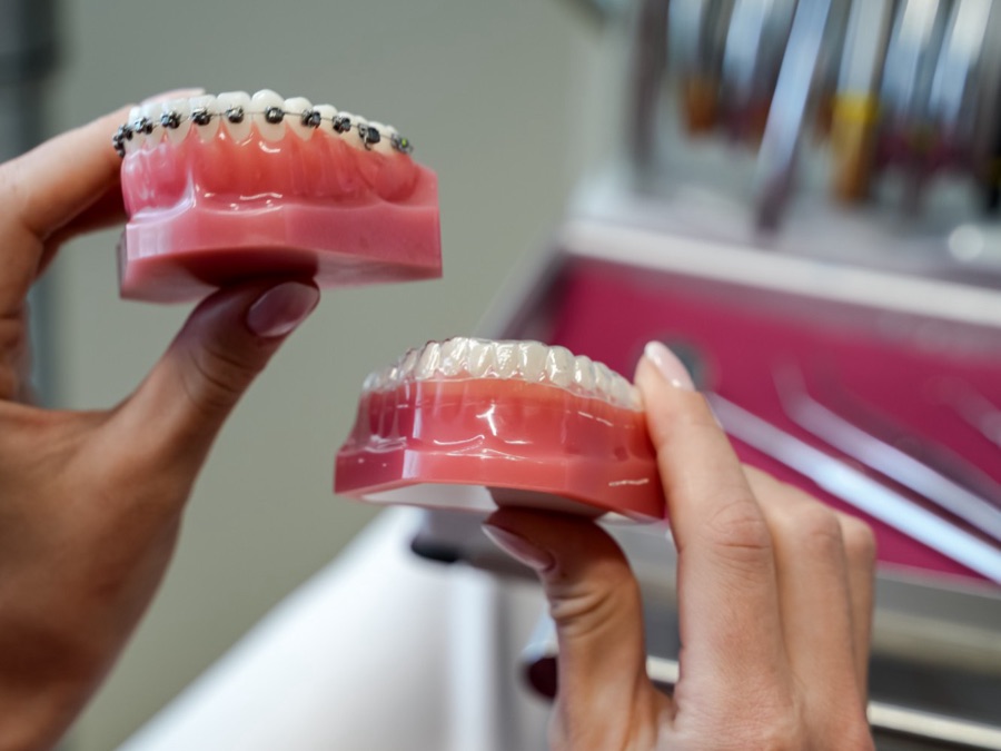 Zwei Kiefermodelle zum Vergleich: oben mit festen Brackets, unten mit einem durchsichtigen Aligner
